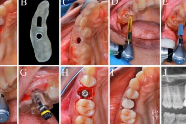 what implants does r2gate us