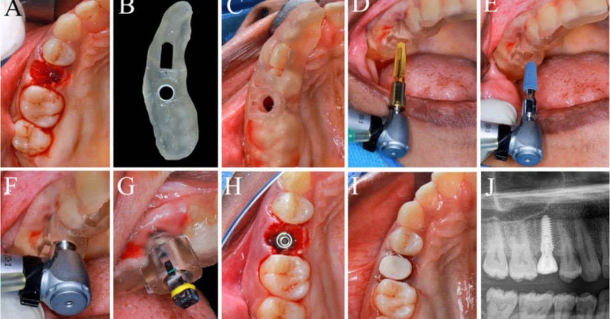 what implants does r2gate us